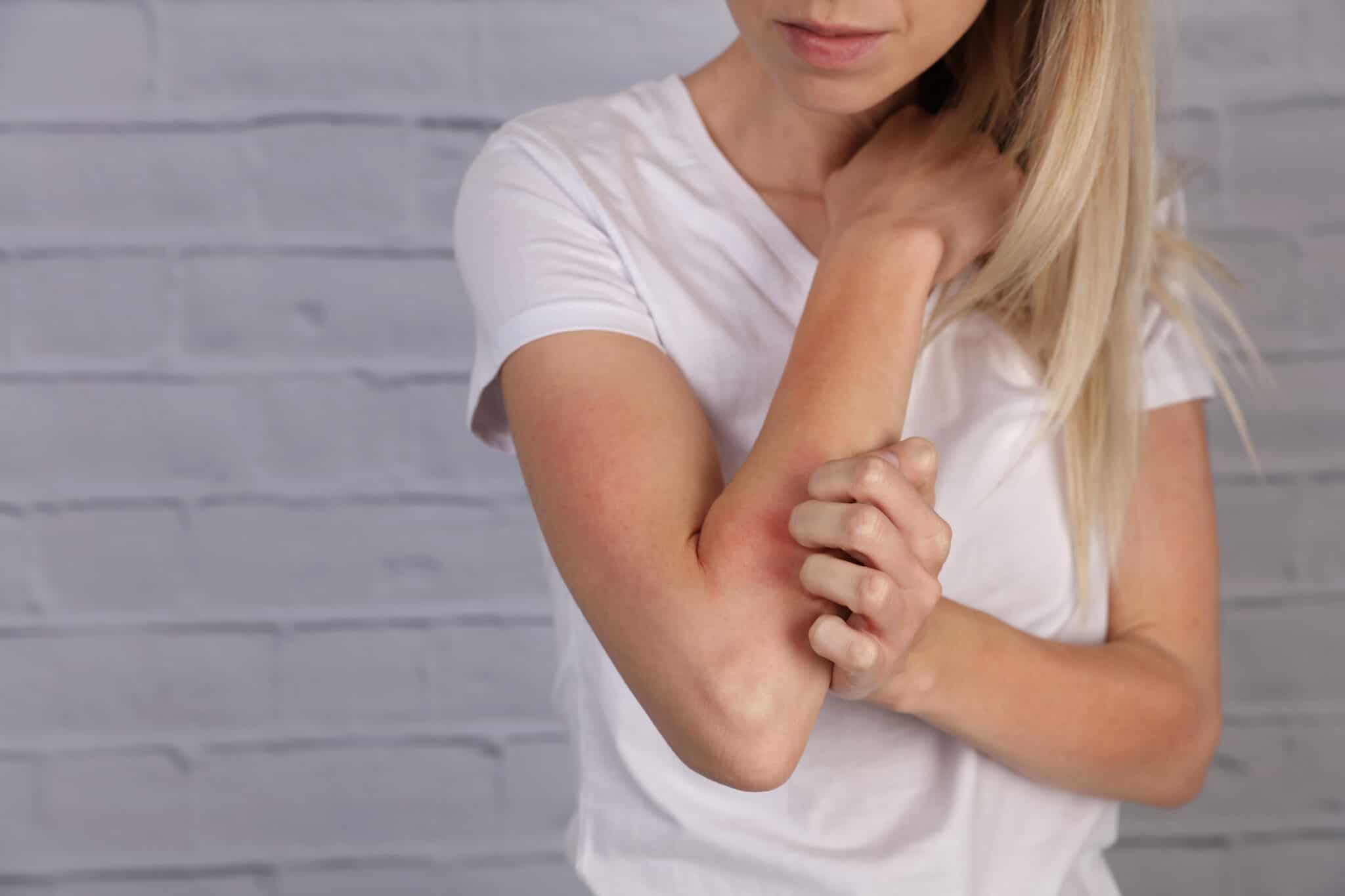 skin allergies blog